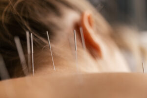 Dry Needling / Trigger Points